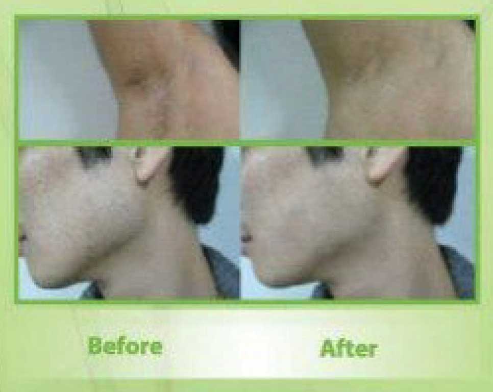 AMT - Olive Plus Laser for Hair Removal